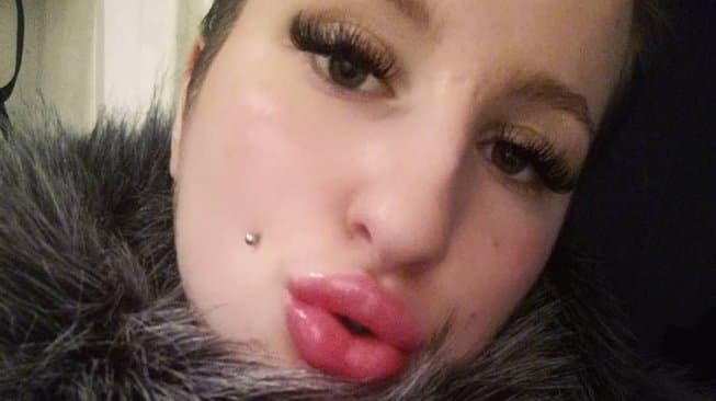 Ingin Seksi, Wanita Ini 10 Kali Filler Bibir dan Habiskan Biaya Fantastis