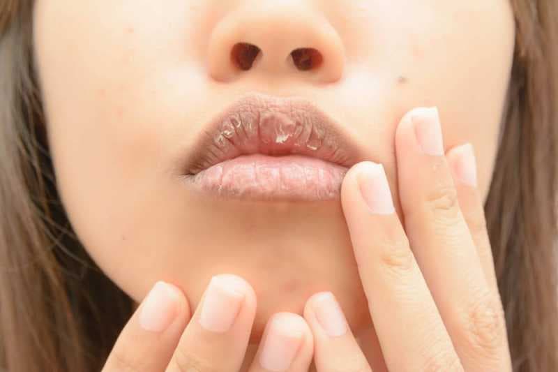 6 Kiat Jitu Mengatasi Bibir Kering dan Pecah-pecah